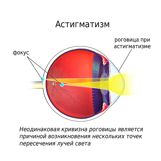 Астигматизм высокой степени