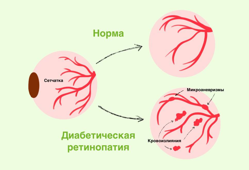 Диабетическая ретинопатия – симптомы, лечение, диагностика