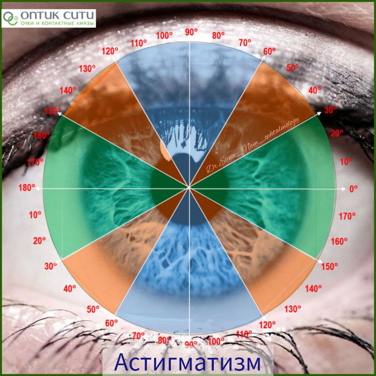 Степени астигматизма