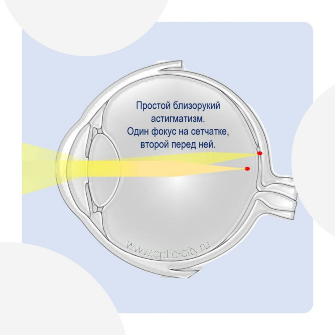Простой близорукий астигматизм