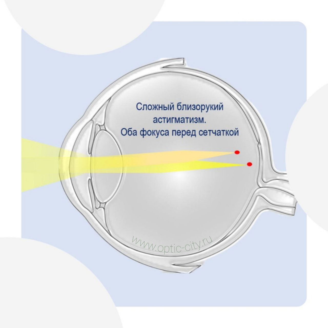 Сложный близорукий астигматизм