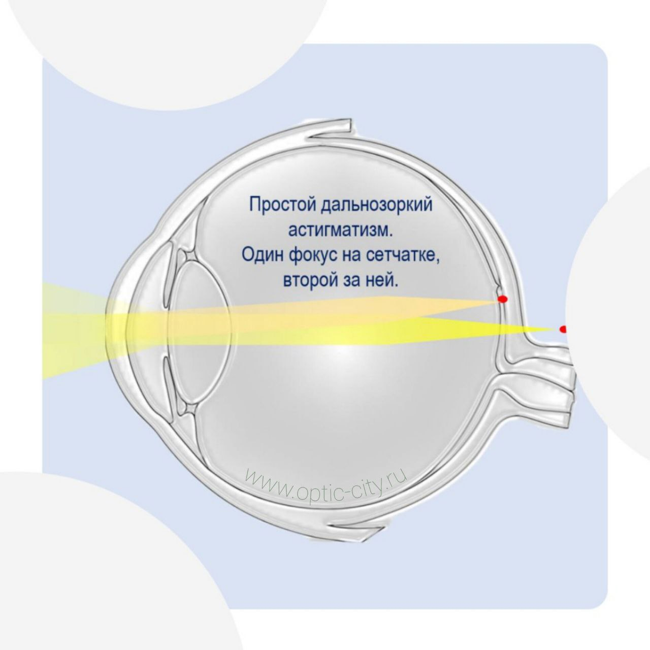 Простой дальнозоркий астигматизм