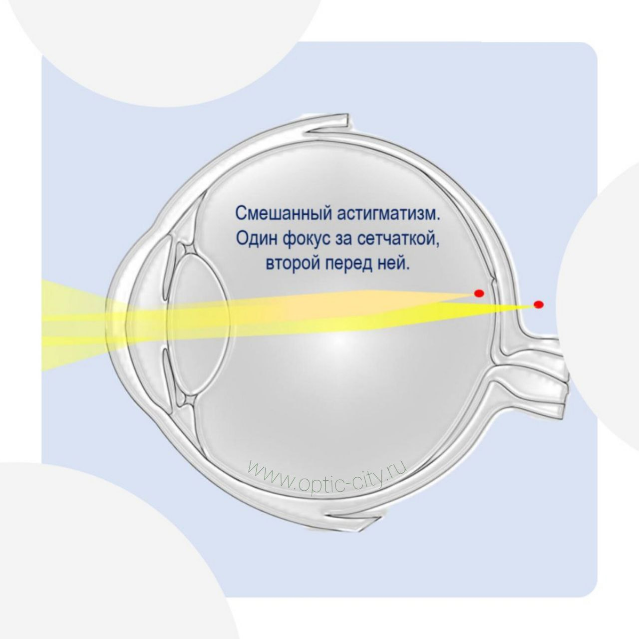 Смешанный астигматизм