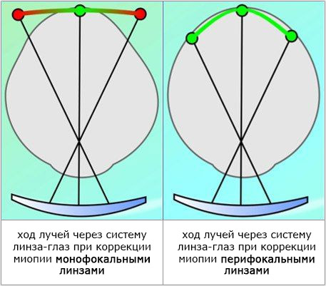 Близорукость у ребенка: причины, симптомы, диагностика, лечение