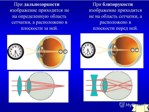 Дальнозоркость и близорукость