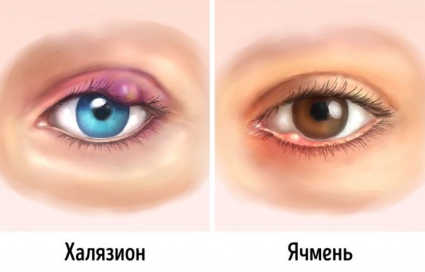Симптомы ячменя на глазу
